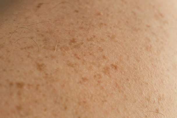 Detalle de cerca de la piel desnuda en un hombre de nuevo con lunares dispersos y pecas. Comprobación de lunares benignos
 - Foto, imagen