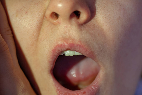 Zere keel close-up bekijken binnen de mond - Foto, afbeelding