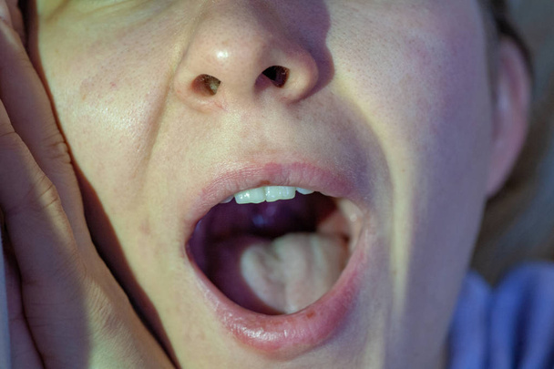 Sore throat closeup view inside mouth - Photo, Image