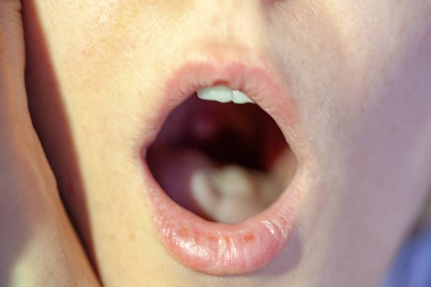 Sore throat closeup view inside mouth - Foto, afbeelding