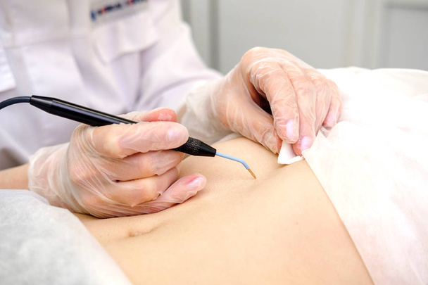 Orvosi kezelés eltávolítása anyajegy a női beteg gyomrát. Női bőrgyógyász sebész segítségével Elektrokauterizáció eltávolítására anyajegy a hasa. Rádióhullám elektrokoagulációs eltávolítása módszer - Fotó, kép