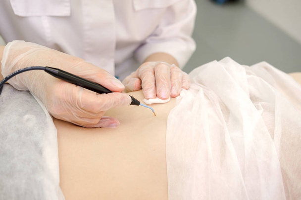 女性患者の胃からの母斑の内科的治療の除去。女性の皮膚科医は、腹のモルを除去するために電気焼灼器を使用します。電波電気凝固除去方法 - 写真・画像