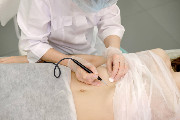 Kadın hastanın mide Doğum lekesi tıbbi tedavi kaldırılması. Kadın dermatolog cerrah göbek mol kaldırmak için elektrokoter kullanarak. Radyo dalgası elektrokoagulasyon kaldırma yöntemi - Fotoğraf, Görsel
