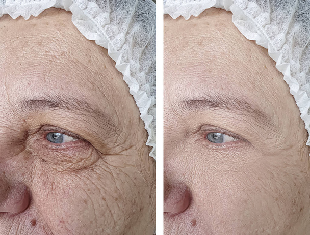 лицо пожилой женщины до и после процедур
 - Фото, изображение