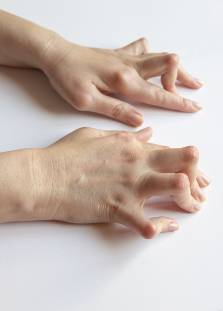 Młode kobiety ręce zdeformowane z reumatoidalnego zapalenia stawów. - Zdjęcie, obraz