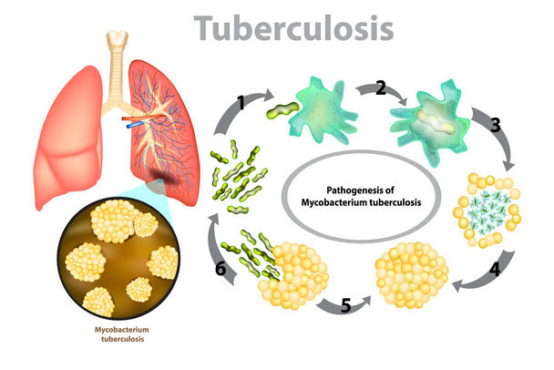 Tuberkuloosi (TB). Keuhkotuberkuloosin eteneminen - Mycobacterium tuberculosis (MTB) bakteerit
 - Vektori, kuva