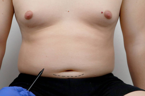Tummy tuck, liposuction, breast surgery. A plastic surgeon prepares a man for plastic surgery. - Photo, Image