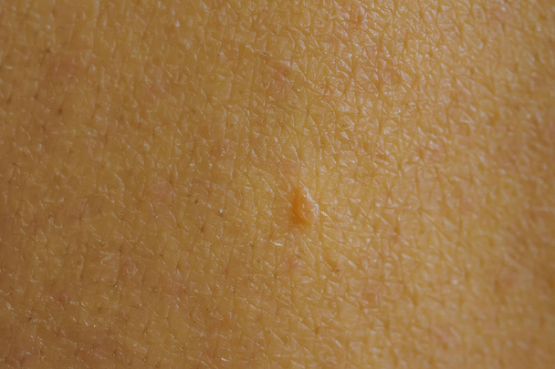 White woman's skin close up. Inflammation and pimples on the face. Problem skin with acne and black spots - Photo, Image