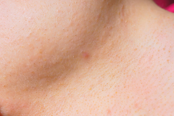 A pele da mulher branca de perto. Inflamação e espinhas no rosto. Problema de pele com acne e manchas pretas
 - Foto, Imagem