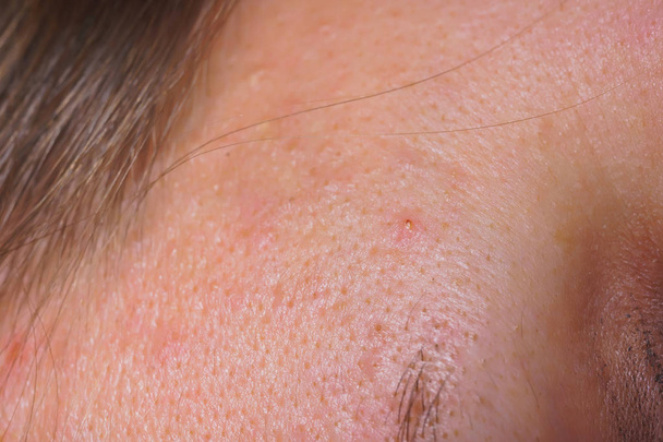 White woman's skin close up. Inflammation and pimples on the face. Problem skin with acne and black spots - Photo, Image