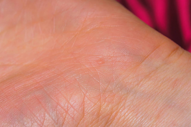 die Textur der Haut der Handflächen. Papillomviren an den Händen im Anfangsstadium. Rettungsleinen zur Hand. - Foto, Bild