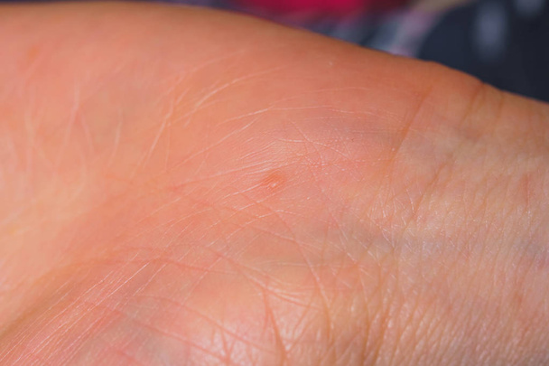 La texture de la peau des paumes. Virus du papillome sur les mains au stade initial. Lignes de vie sous la main
. - Photo, image