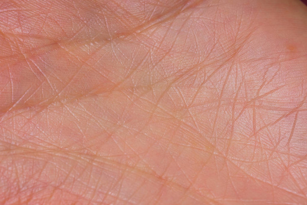 La textura de la piel de las palmas. Virus del papiloma en las manos en la etapa inicial. Líneas de vida a mano
. - Foto, imagen