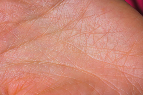 La textura de la piel de las palmas. Virus del papiloma en las manos en la etapa inicial. Líneas de vida a mano
. - Foto, imagen