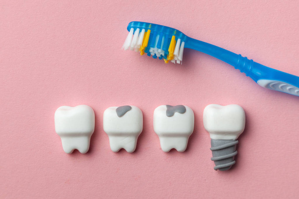 健康な白い歯とインプラントと、ピンクの背景と歯ブラシの上に虫歯のある歯. - 写真・画像