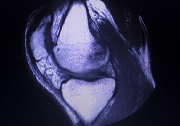 MRI knee meniscus tear scan - Photo, Image