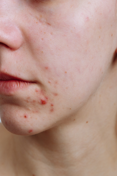 Mujeres jóvenes con piel problemática y granos en la cara. Feamle mostrando su acné. Concepto de cuidado de la piel, belleza y spa
 - Foto, Imagen