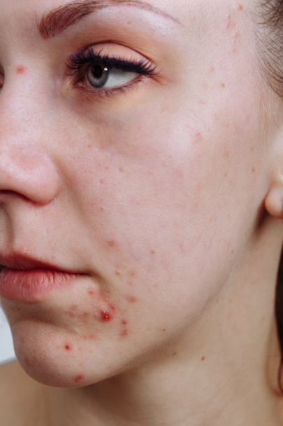 Young women with problematic skin and pimples on her face. Feamle showing her acne. Skincare, beauty and spa concept - 写真・画像