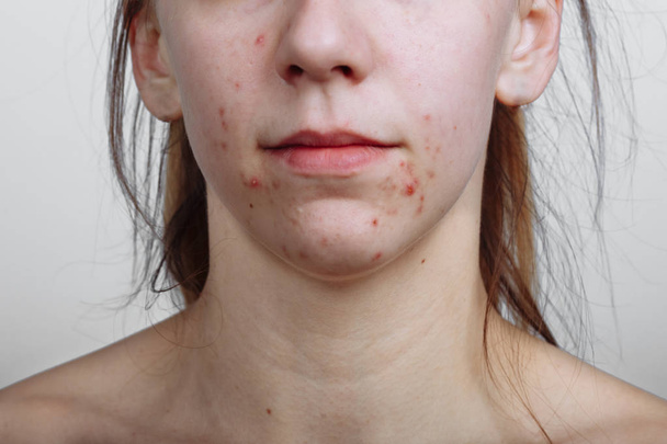 Jonge vrouwen met een problematische huid en puistjes op haar gezicht. Feamle toont haar acne. Huidverzorging, schoonheid en spa concept - Foto, afbeelding