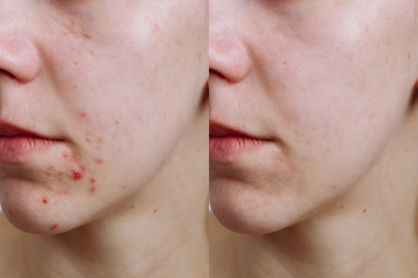 junge Frau vor und nach der Akne-Behandlung, Nahaufnahme. Hautpflegekonzept - Foto, Bild
