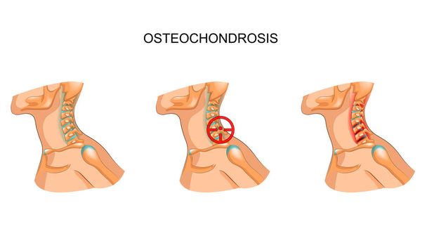 osteocondrosis de las vértebras cervicales
 - Vector, Imagen