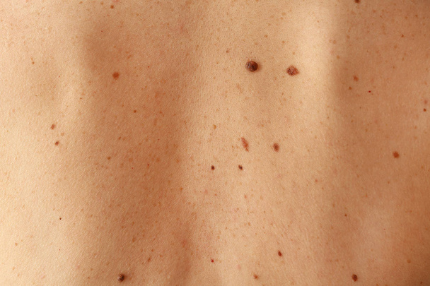 Emberi bőr anyajegy - Fotó, kép