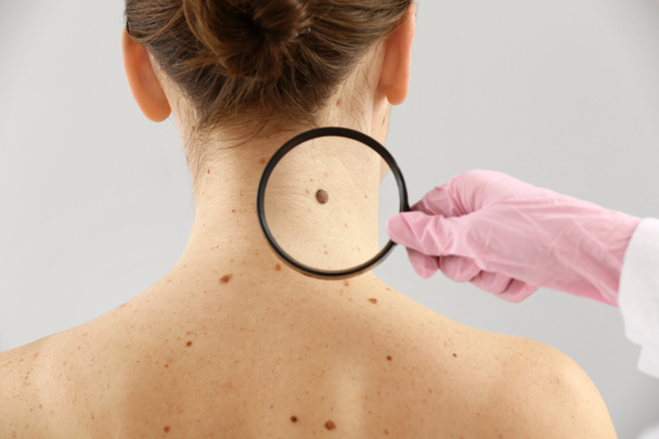 Dermatologist examining moles of patient on light background - Zdjęcie, obraz