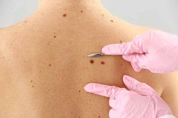 Doctor with lancet going to remove mole from patient's skin, closeup - Foto, afbeelding