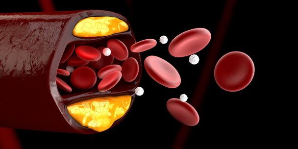 3D απεικόνιση των κυττάρων του αίματος με συσσώρευση πλάκας χοληστερόλης απομονωμένη μαύρο - Φωτογραφία, εικόνα