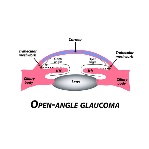 Open-úhlem. Běžným typem glaukomu. Anatomické struktury oka. Infografika. Vektorové ilustrace v izolovaných pozadí. - Vektor, obrázek