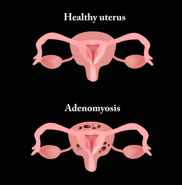 Endometriosis. A kismedencei szervek szerkezete. Adenomyosis. A méhnyálkahártya. Vektoros illusztráció - Vektor, kép