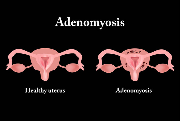Ендометріоз. Структура органів малого тазу. Adenomyosis. Слизовою оболонкою матки. Векторні ілюстрації - Вектор, зображення
