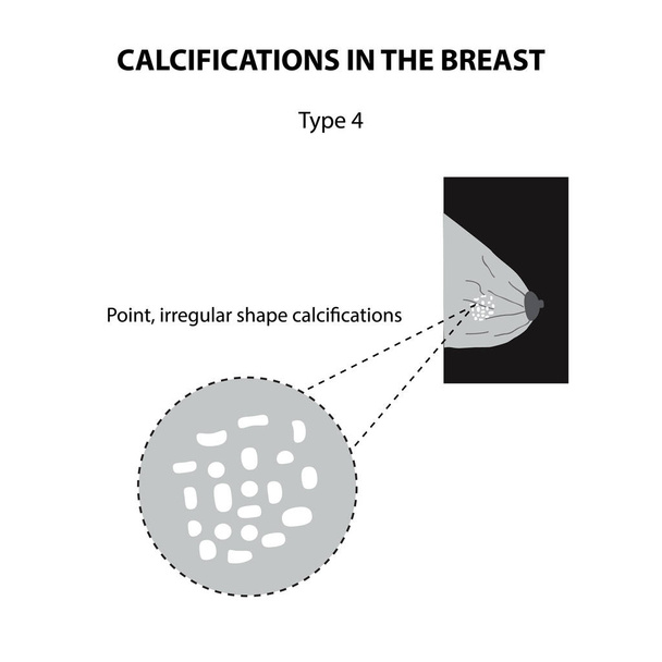 A mell meszesedés. Mammográfia. A tejmirigy. Infographics. Elszigetelt háttér vektor illusztráció - Vektor, kép