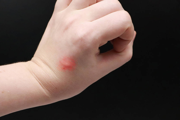 Rötung und Juckreiz am Arm. der Arzt untersucht die Hand, an der der Stich eines Insekts, einer Mücke - Foto, Bild