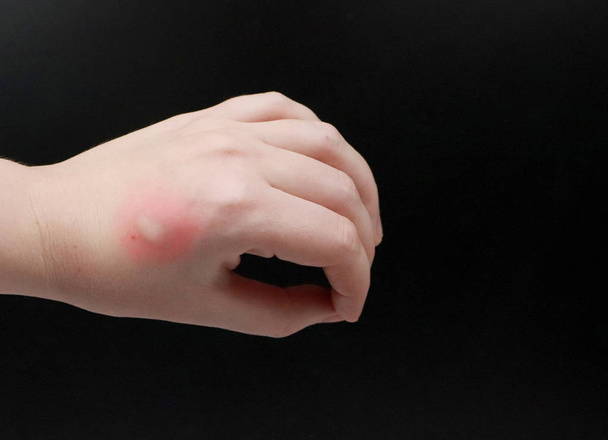 腕の赤みとかゆみ。医者は昆虫、蚊に刺された手を調べる - 写真・画像
