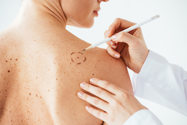 bijgesneden beeld van dermatoloog aanbrengen van markeringen op de huid van naakte vrouw met melanoom geïsoleerd op wit  - Foto, afbeelding