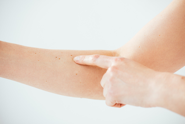 vista cortada da mulher apontando com o dedo para o melanoma no branco
  - Foto, Imagem