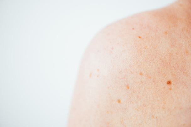 vista ritagliata della donna con melanoma sulla spalla mentre
 - Foto, immagini