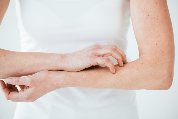 rajattu näkymä allerginen nainen raapimalla kädet valkoinen
  - Valokuva, kuva