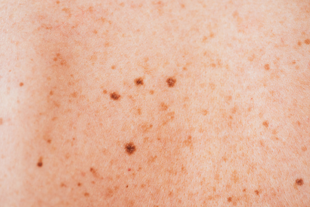 close up of sick woman with melanoma on diseased skin  - Photo, Image