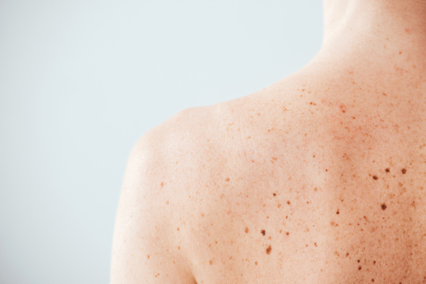 back view of diseased woman with melanoma on skin on white  - Fotó, kép