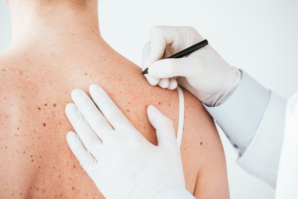 visão recortada de dermatologista em luvas de látex branco segurando caneta marcador perto de mulher com melanoma isolado em branco
  - Foto, Imagem