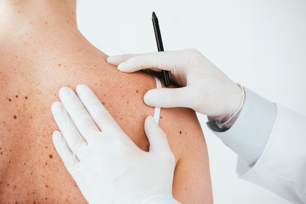 przycięte widok dermatologa w Rękawice lateksowe trzymając marker pióro blisko kobiety z czerniakiem na białym tle  - Zdjęcie, obraz