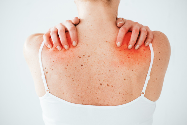 back view of sick woman with allergy scratching red skin on white  - Фото, зображення