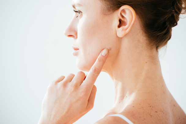 attractive woman pointing with finger at mole on face isolated on white  - Photo, Image