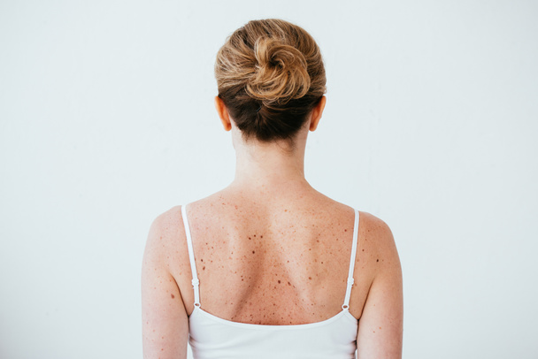 vista posteriore di donna con melanoma su pelle malata isolata su bianco
  - Foto, immagini