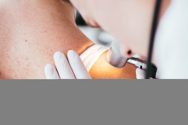 vista recortada del dermatólogo que sostiene el dermatoscopio mientras examina a una mujer con melanoma
  - Foto, Imagen