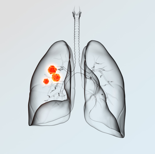 Cáncer de pulmón, ilustración médicamente 3D sobre fondo claro
 - Foto, imagen