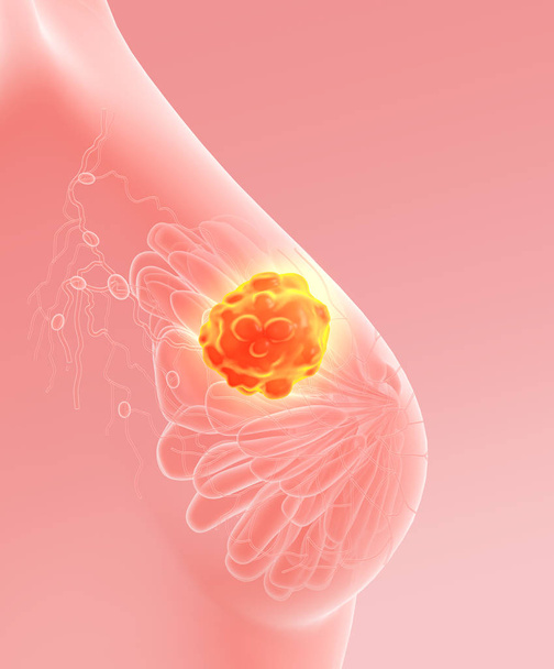 リンパ薬で乳がんを示す3Dイラスト、ピンクの背景に医学的に3Dイラスト - 写真・画像