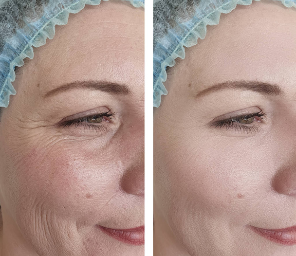 женщина морщит до и после процедур
 - Фото, изображение